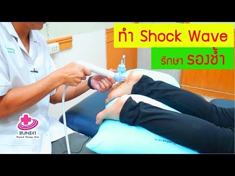 การรักษารองช้ำด้วยกายภาพบำบัด ซ็อคเวฟ Shock wave therapy