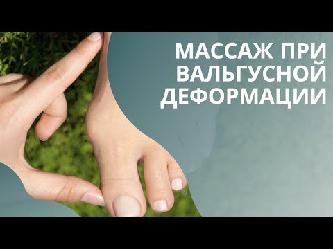 Реабилитация после операции Hallux Valgus
