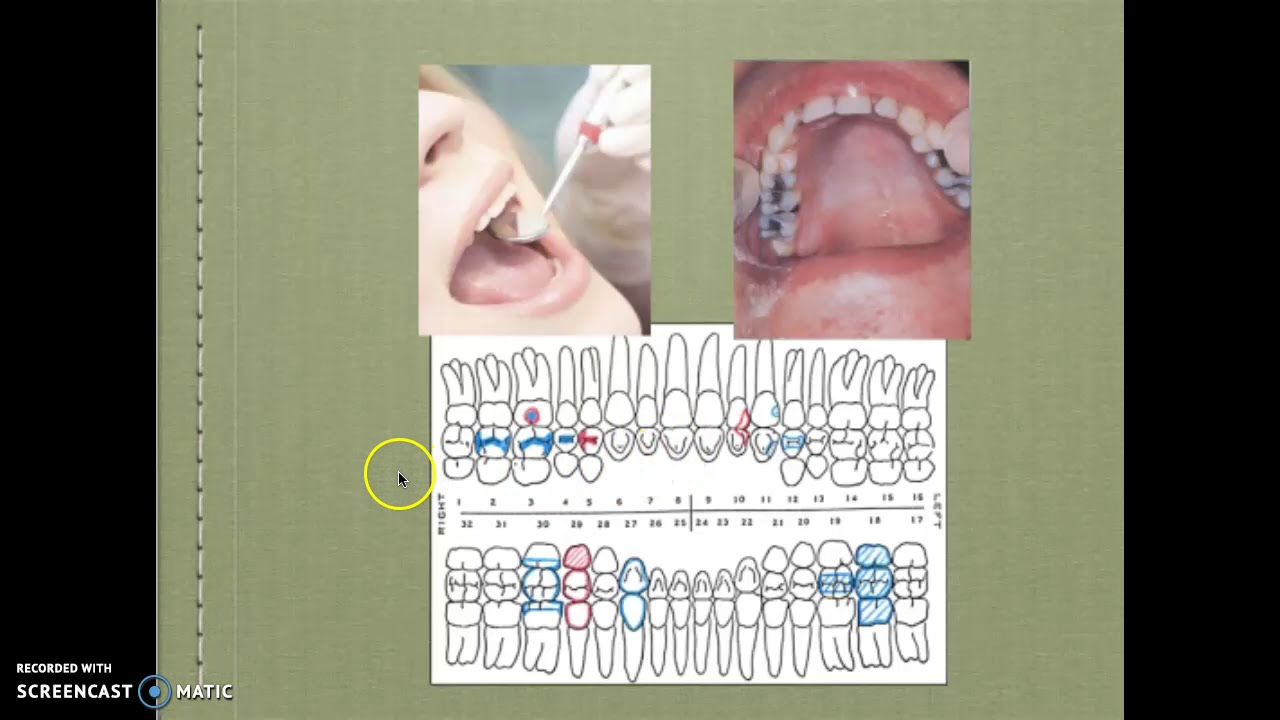 Mouthmirror Inspection For The RDA YouTube