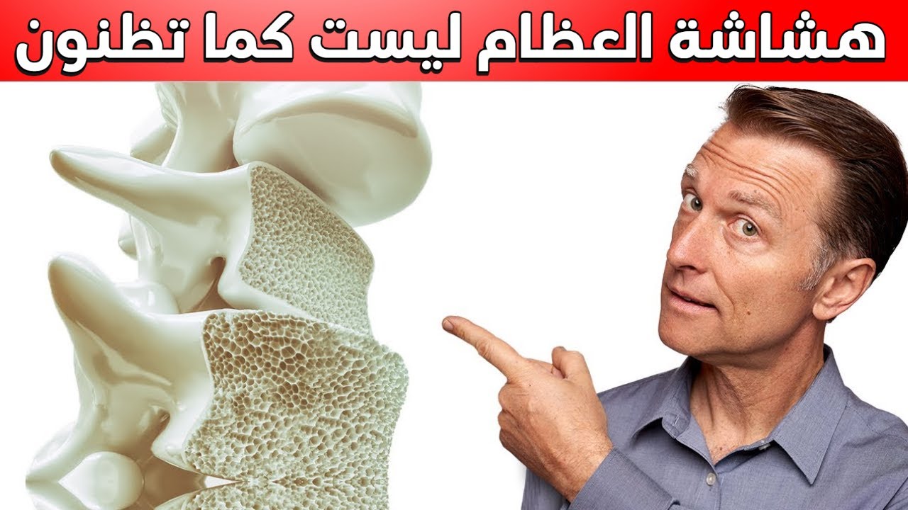 شيء أهم من الكالسيوم وراء هشاشة العظام