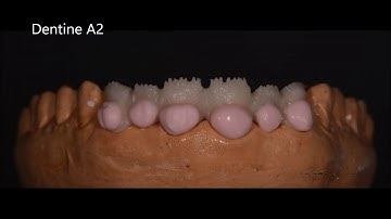 Zirconium e-max ceram build up Cut-back , zro2 , E.max ceram