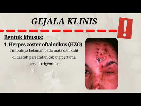 HERPES ZOSTER #Bulletindisease #Augustedition