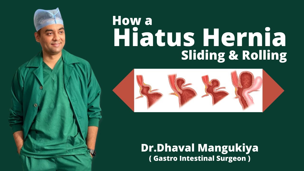 How a Hiatus Hernia Sliding & Rolling is Formed Symptoms and Treatment Dr.Dhaval Mangukiya