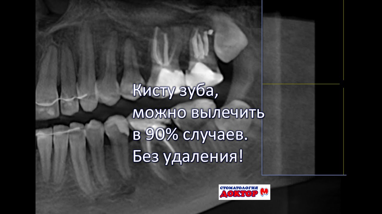 Лечение кисты зуба, возможно в 90% без удаления!