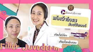 Review #ฉีดฟิลเลอร์ ของคุณมิ้น 🗣 #ฟิลเลอร์ขมับตอบ ขมับบุ๋ม #ฟิลเลอร์หน้าแก้ม