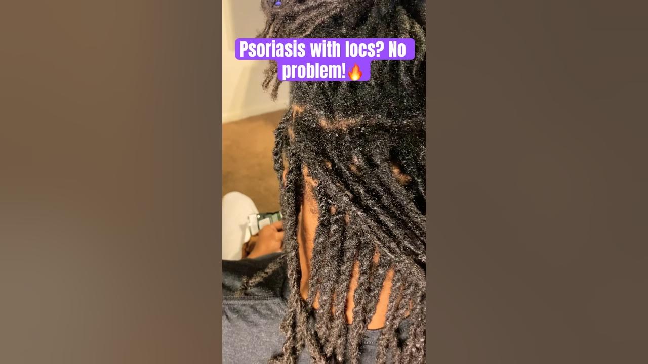 You can’t even tell he has dry flaky scalp! #psoriasis #locs #hair # ...
