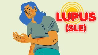 Systemic Lupus Erythematosus (updated 2023)  CRASH! Medical Review Series