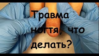 ТРАВМА НОГТЯ!Что делать?весь процесс до и после/слабонервным не смотреть