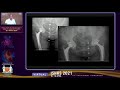 Complex total hip arthroplasty  dr nikhil shah