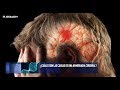 Mitos y realidades de la hemorragia cerebral