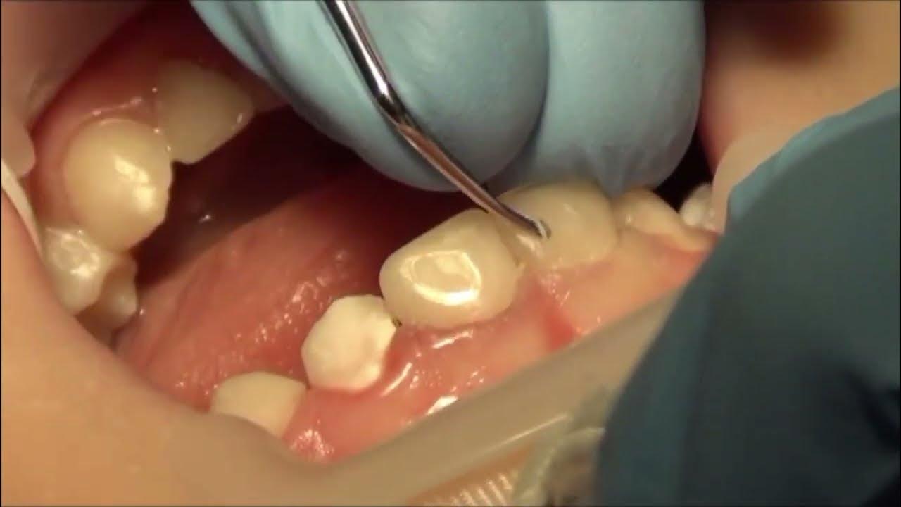 FNPD Techniques Composite Resin Strip Crowns in Pediatric Dentistry