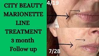 CITY BEAUTY MARIONETTE LINE TREATMENT 3 MONTH FOLLOW UP / BEAUTY OVER 50