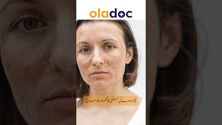 Skin Dryness Causes & Treatment - Chehre Ki Khushki Ka Ilaj