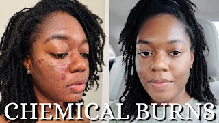 I RUINED my Skin! Fixing Chemical Burns, Scarring, and Dark Spots NOW