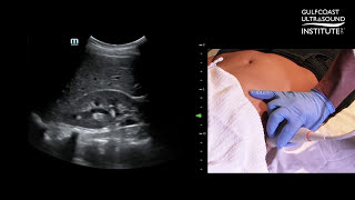 Hot Tip -  How to Locate the Gallbladder With Ultrasound