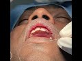 Double Lip Correction - Smile Designing Mucosa Surgery