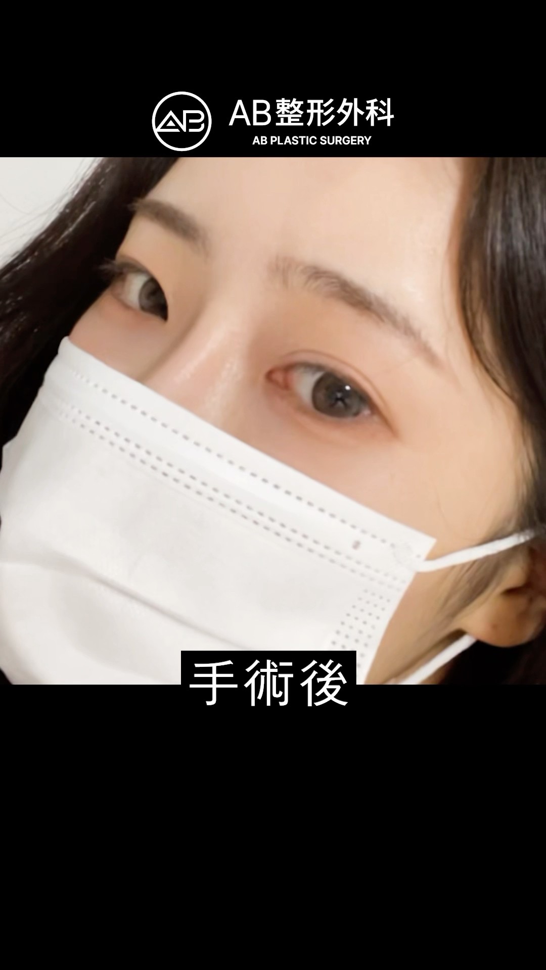 無雙眼做雙眼皮手術會怎樣？#shorts