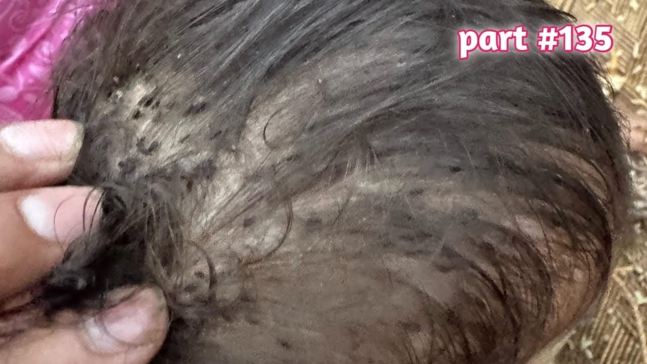 #nitsremoval  wife removed husband lices super video || long hair lice remove 👧part 135