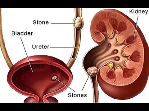 Kidney Stone Size Chart