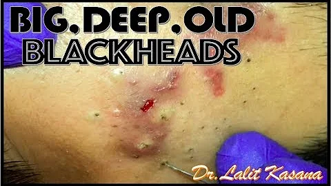 BIG DEEP OLD BLACKHEADS REMOVAL BY DR.LALIT KASANA...