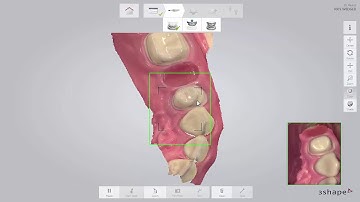 3Shape TRIOS - Workflow für Brücken
