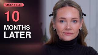 I Added Cheek Filler for Lift—Did It Make Me Look Puffy?