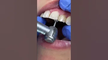 BRACES OFF Reels Drshullman Shullmanorthodontics 