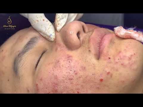 #57 #loannguyen_PROFESSIONAL ACNE TREATMENT_ Tratamiento profesional para el acné