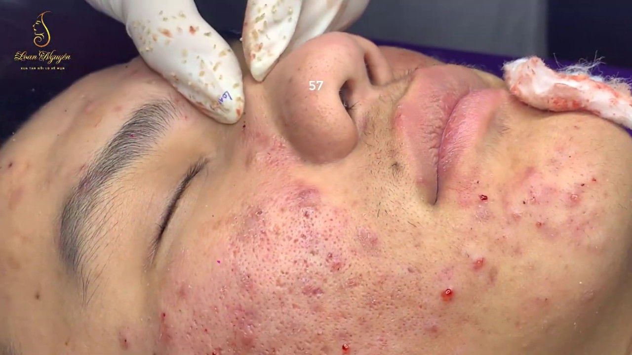 Professional acne treatment