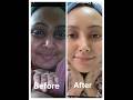 dull to bright and glowing skin transformation✨😘 #ytshorts #skincare #transformation