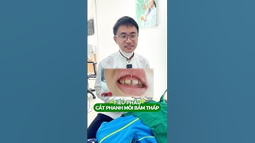 Phanh môi bám thấp có thể gây ra lệc răng, khớp cắn cho trẻ. Bố mẹ nên đưa trẻ đi khám sớm.