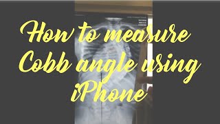 Measuring the Cobb angle using the Measure app on iPhone (iOS)