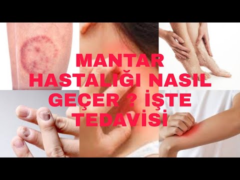 Mantar Hastalığı Nasıl Geçer ? İşte Tedavisi !