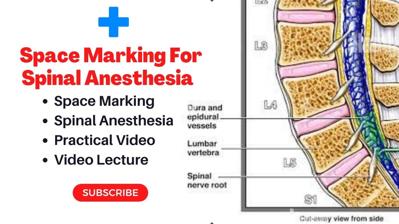 Space Marking For Spinal Anesthesia By Anesthesia Technologist How space-marking-for-spinal-anesthesia-by-anesthesia-technologist-how