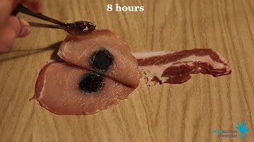 This video shows the harm a button battery can do to a child