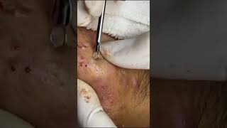 Extraordinary acne removal video  acnetreatment skincare