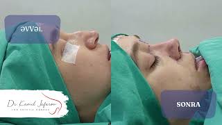 Revizyon Rinoplastika - Kamil Jafarov