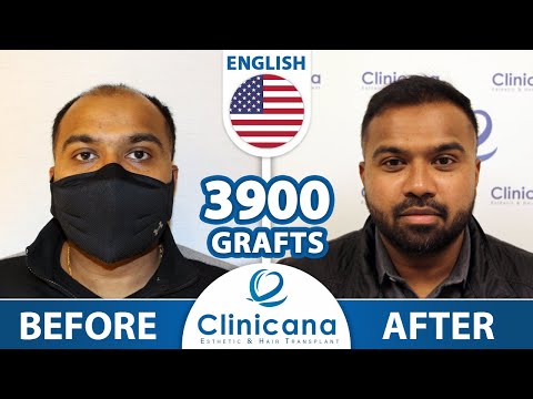 Roy’s hair transplant