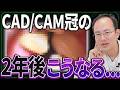 CAD/CAM冠のデメリットは...保険の白い歯が数年経ったらどうなるか症例とともに解説します！