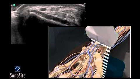 How To: Ultrasound Guided Radial Artery Catheterization (Trans) 3D Video