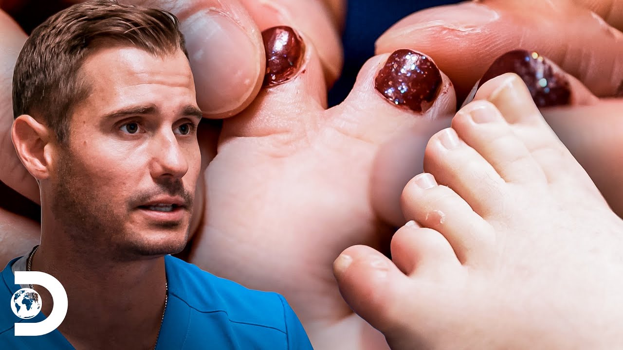 Cirurgias incríveis para tratar deformidades no dedo | Meus Pés Estão Me Matando | Discovery Brasil