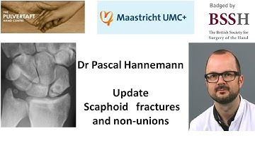 Update management of scaphoid fractures and non union