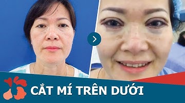 Cắt mí mắt trên dưới Plasma + Xóa rãnh lệ cho việt kiều Mỹ