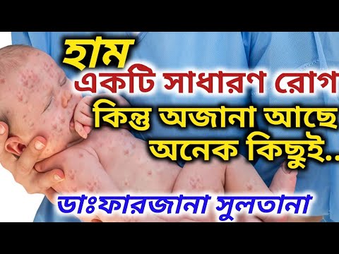 ভিডিও: শিশুদের মধ্যে হাম: লক্ষণ ও চিকিৎসা