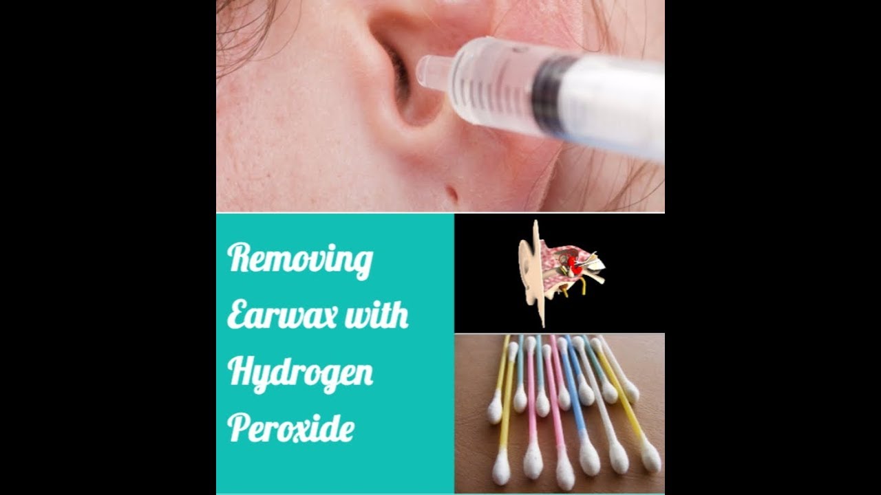 how to use hydrogen peroxide eardrop to remove impacted ear wax buildup ear wax buildup impacted ear wax dry skin routine