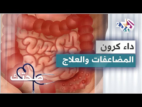 داء كرون الأسباب والمضاعفات والتشخيص والعلاجات المتوفرة