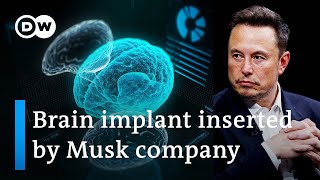 Elon Musk's startup Neuralink implants first chip in human brain | DW News