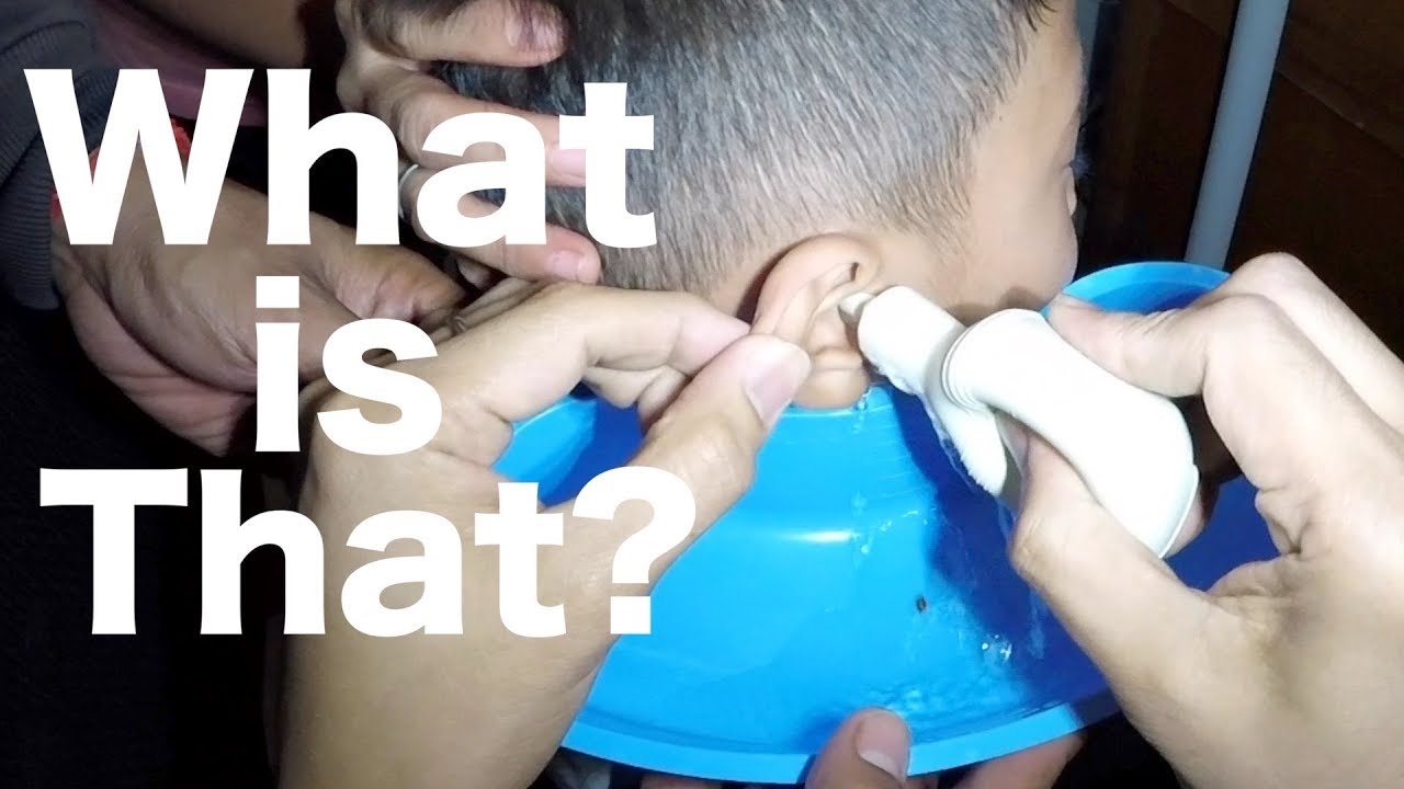 Ear Irrigation of Foreign Body Stuck in Boy's Ear What is It? YouTube