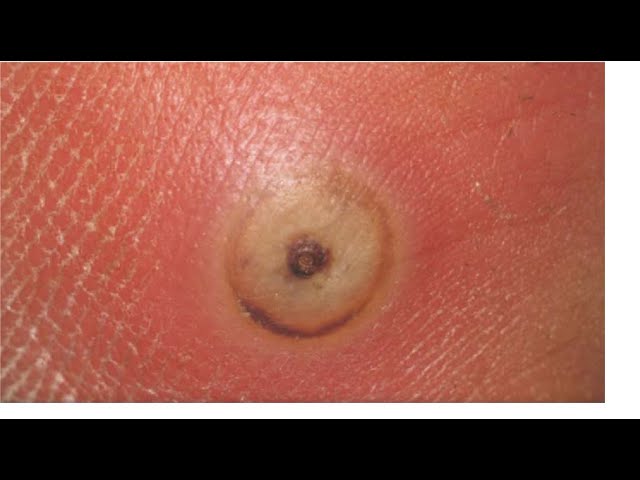Tungiasis: Debilitating Skin Condition Caused by Sand Flea Infestation 