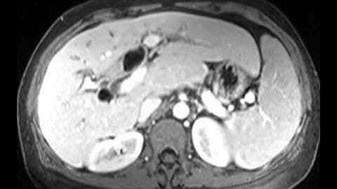 Hilar Cholangiocarcinoma